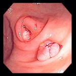 Small Mouth Diverticula 102
