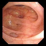 Small Mouth Diverticula 49