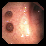 Small Mouth Diverticula 84