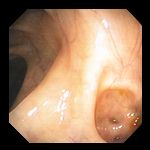 Small Mouth Diverticula 22