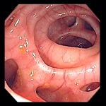 Small Mouth Diverticula 89