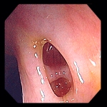Small Mouth Diverticula 21